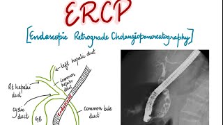 ERCP Endoscopic Retrograde Cholangiopancreatography presentation for medical students [upl. by Standice]