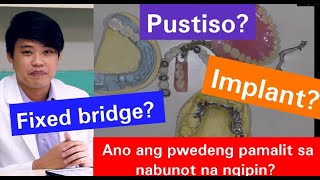 Nabunutan Anu ang Mga Puwedeng Pamalit sa Nabunot ng Ngipin Pustiso Bridge Jacket Implant 19 [upl. by Olen31]