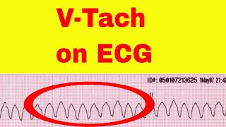 Ventricular Tachycardia on ECG [upl. by Nylimaj88]