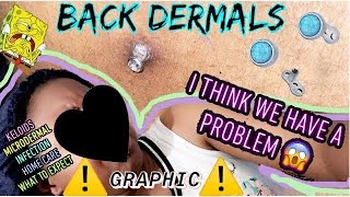 ALL YOU NEED TO KNOW “Graphic” BACK Dermal piercing video 💯🤯INFORMATIVE [upl. by Yaras634]