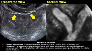 Congenital Uterine Anomalies Ultrasound Reporting  Didelphys Bicornuate Unicornuate Uterus USG [upl. by Berghoff]