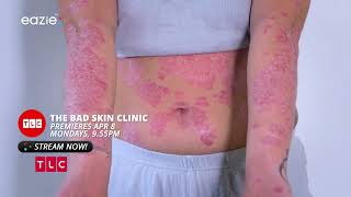 Mystery Bumps amp Rashes 😱👩‍⚕️💼  The Bad Skin Clinic  Eazie TV [upl. by Oettam]