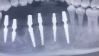 Aggressive periodontitis Simpladent India KOS dental implants for lower anterior teeth [upl. by Nibor]