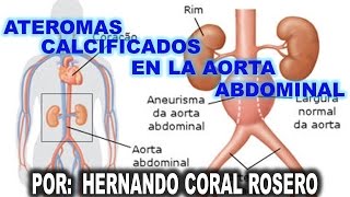 ATEROMAS CALCIFICADOS EN LA AORTA ABDOMINAL [upl. by Oknuj]