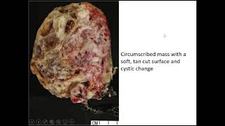 Renal Tumors Case 6 [upl. by Fanchan]