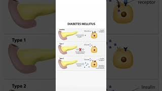 Metabolic disorder Diabetes Mellitus Type1 and Type2 [upl. by Ballou]