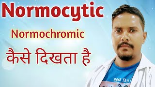 normocytic normochromic in hindi  Normocytic anemia  RBC indices in hindi [upl. by Trenna]