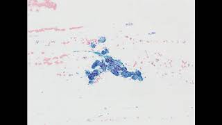 Parotid mass Acinic cell carcinoma Alcoholfixed smear [upl. by Anson]