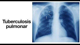 ¿Qué es la tuberculosis  ¿Cómo se contagia  Tuberculosis pulmonar  Síntomas y Tratamiento [upl. by Adnuhsor]