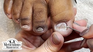 Toenail Fungus at Home Remedy [upl. by Elorac]