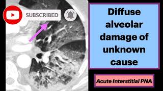 Acute Interstitial Pneumonia Radiology Pulmonology Medicine [upl. by Eydie]