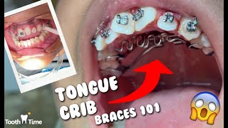 Dental Braces Tongue Crib  RPE  Tooth Time New Braunfels Texas Orthodontics [upl. by Oranneg]