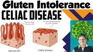 What is Celiac Disease  What can I eat as glutenfree diet  Foods to avoid in Celiac ajaykaushik [upl. by Earlene]