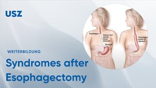 Functional syndromes after Esophagectomy – Please participate in our 3minute survey below [upl. by Carilla]