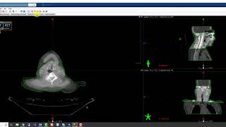 Varian Eclipse Image Fusion Basics [upl. by Read]