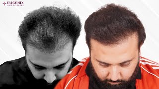 A hair transplant at Eugenix transformed Sumit’s life from 3535 grafts [upl. by Pearl204]