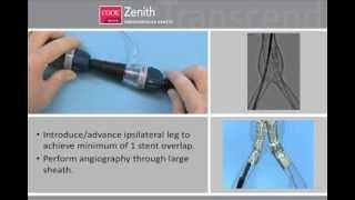 Endovascular Graft Zenith AAA Flex [upl. by Ainyt]