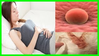 Implantation Bleeding or Miscarriage  Common gynecologic problems [upl. by Ylevol]