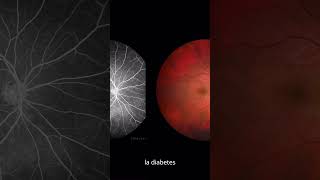 ¿Qué causa la retinopatía diabética salud diabetesmellitustipo2 prevencióndeenfermedades [upl. by Bilski45]