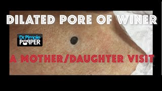 A giant blackhead extracted in an 85 yo accompanied by her daughter [upl. by Melc]