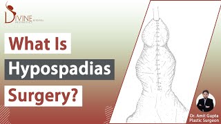 Dr Amit Gupta Explained About Hypospadias  Types Causes Symptoms amp Treatment [upl. by Arabrab]