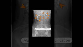 Medullary nephrocalcinosis due to type 1 renal tubular acidosis virlshorts [upl. by Christoforo240]