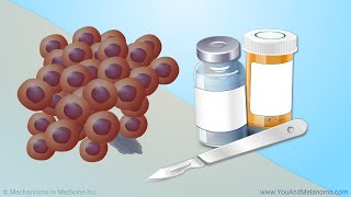 Treating Melanoma [upl. by Sonnnie]