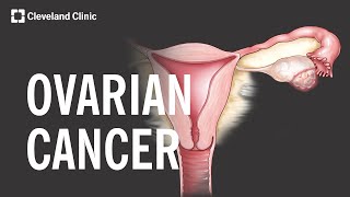 5 Warning Signs and Risk Factors of Ovarian Cancer [upl. by Remos]