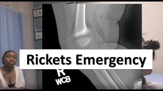 Rickets in the Pediatric Emergency Department [upl. by Tioneb]