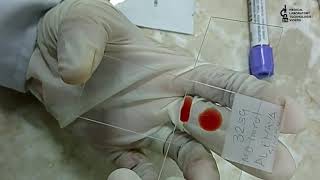 Blood smear preparation2 methods to learnThick amp Thin smear preparation [upl. by Ydnak]