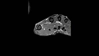 Extensor pollicis tendon longus EPL tendon rupture [upl. by Keppel]