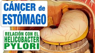 Cáncer de Estómago y Helicobacter pylori [upl. by Ayhay29]