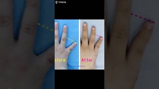 brachydactyly 短指症手術 短指症 단지증 단지증수술 단지증수술후기 braquidactilia عضدي الأصابع брахидактилия [upl. by Ayekat62]