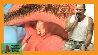 PAINFUL DENTAL ABSCESS DRAINED  Auburn Medical Group [upl. by Oninotna858]