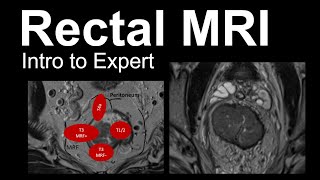 Rectal MRI Intro to Expert Rectal Cancer Staging [upl. by Garbe762]