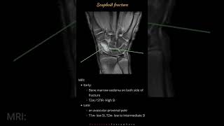 Scaphoid fracture  Wrist bone fractures  Radiology tutorials by Radiology Everywhere [upl. by Stalker]