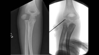 Percutaneous Screw Fixation of Lateral Condylar Humeral Fractures [upl. by Emelin]