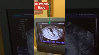 10 Week Baby 😱😱  USG  Bsc Nursing Students life youtubeshorts trendingshorts ytshorts shorts [upl. by Lenej695]