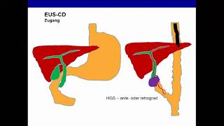 0307 Endosummer 2019 – Interventionelle Endosonographie – Wo stehen wir heute Dr Eike Burmester [upl. by Onilegna]