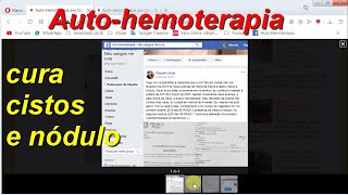 Autohemoterapia cura cistos e nódulo em menos de 4 meses [upl. by Annekim]