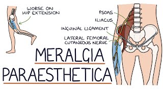 Understanding Meralgia Paraesthetica [upl. by Yllet611]