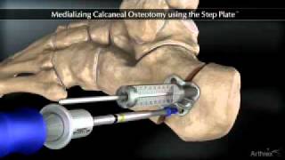 Medializing Calcaneal Osteotomy [upl. by Lerrud]