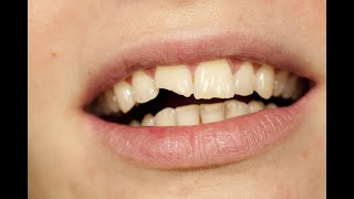 Chipped Tooth Soquel CA 831 2261218 [upl. by Ellegna169]