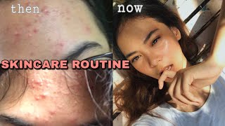 HOW I LOST MY PIMPLES IN 1 MONTH  my acne story  Amelia Salve [upl. by Lundgren]