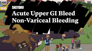 Acute Upper GI Bleed Lesson NonVariceal BleedingFull Lesson  Sketchy Medical  USMLE Step 2 CK [upl. by Asecnarf454]