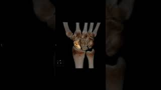 scaphoid bone fracture shortsfeed 3d [upl. by Nolana]