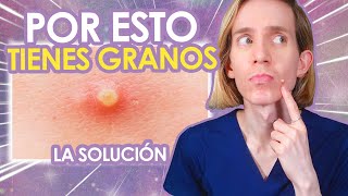 5 RAZONES por las cuales TE SALEN GRANITOS  Como SOLUCIONARLAS  Simon Scarano Dermatologo [upl. by Anahsor502]