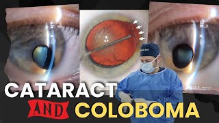 Colobomas amp Cataract Surgery  A Patients Case [upl. by Asyar615]