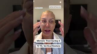 DAY 4 of Facelift Healing amp Recovery How its ACTUALLY Going [upl. by Ariaet]