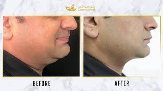 NonSurgical Double Chin Reduction Injection lipolysis [upl. by Nylaj]